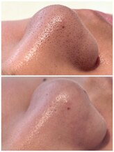 ピュア 川越店/毛穴プレミアムコース