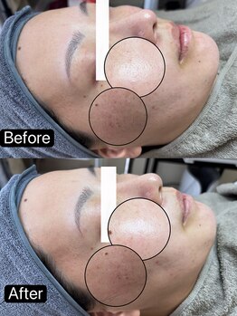 リル(Rire)/Before→After　40代