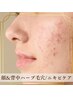 【ダウンタイム無し☆毛穴/ニキビを徹底ケア】背中＋顔ハーブピーリング