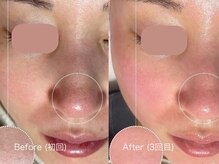 ウルト アルティメイトスキン(ULT ultimate skin)/今話題のスノーピール♪