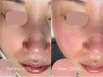 ウルト アルティメイトスキン(ULT ultimate skin)/今話題のスノーピール♪