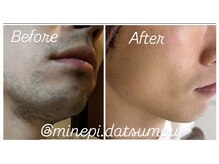 ミンエピ(MinEpi)/メンズ顔脱毛ビフォーアフター♪