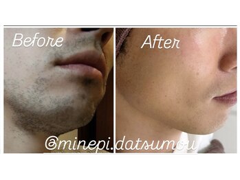 ミンエピ(MinEpi)/メンズ顔脱毛ビフォーアフター♪