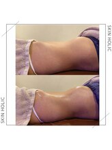 スキンホリック 恵比寿駅前店(SKIN HOLIC)/お腹☆ビフォア＆アフター★