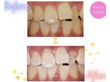 エクシアホワイトニング 天王寺店/ホワイトニングビフォーアフター
