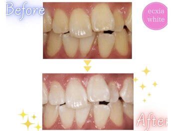 エクシアホワイトニング 天王寺店/ホワイトニングビフォーアフター