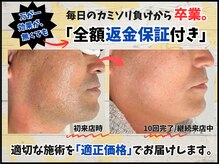 毛抜き屋 可児店/◇当店の看板メニューひげ脱毛◇