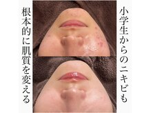 リッチ(Rich)の雰囲気（長年ずっと悩んできた頑固なニキビも根本改善！）