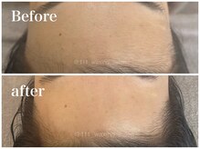 トリプルワン(111)/クラニオフェイシャルワックス