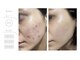 アンド ミヨン(And Miyon)の写真/"その場で調合”オーダーメイド式肌管理『トロイアルケ』×当サロンだけのマシン併用セットで結果重視