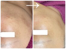 フォーチューン/ハーブトリートメント