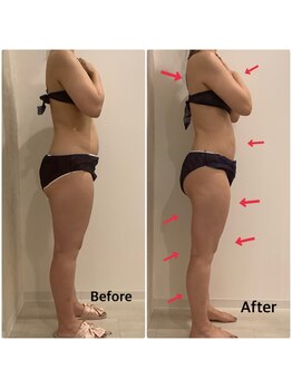 スペチアーレ 夙川/ハイパーナイフで代謝UP