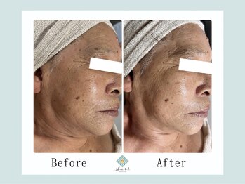 エステティックルーム サリ(Aesthetic Room SARI)/たるみ改善ビフォーアフター♪