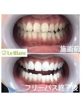 ルブラン 奈良店(Le Blanc)/比較写真で分かる効果