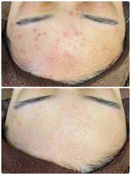 ビオエル 横浜店(Bioel)/【ハーブピーリング 横浜】