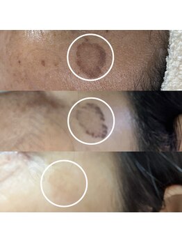 ニュアージュ(Nuage)/60代女性/シミケア10日の経過