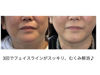 ラ ヴォワ 東銀座(La Voix)/前回リンパ+小顔コルギ