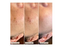 ルージュアッシュ(ROUGE.H)の雰囲気（シミケア得意◎お肌のお悩み教えて下さい！わくわく肌質改善♪）
