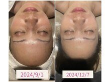 インチャント(enchant)/よさこい日焼けケア