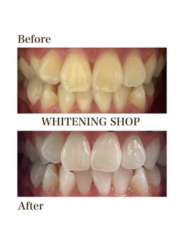 ホワイトニングショップ 恵比寿店/【Before After】