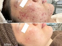 ニキビケア研究所 横浜店/お顔全体のニキビケア