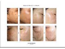 シャインプラス(Shine+)