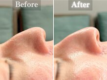 ボーンオム(Born Homme)/毛穴洗浄＋美容液導入：30代男性