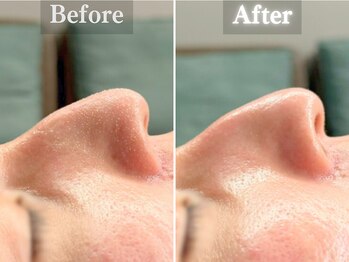 ボーンオム(Born Homme)/毛穴洗浄+美容液導入:30代男性