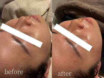 コモレビ(komorebi)/町田/フェイスワックス/顔脱毛