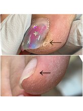 リネイル 長浜(Re-na-iL)/ネイルケア＆スパ¥7000