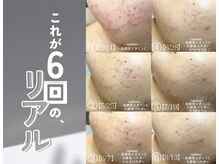 ソアスキン(SOAskin)