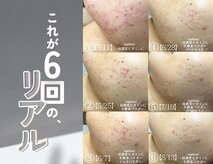 ソアスキン(SOAskin)