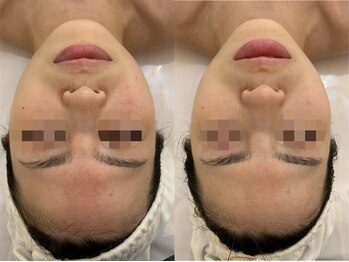 ナラビューティー(NARA BEAUTY)/輪郭リフト1回効果小顔恵比寿