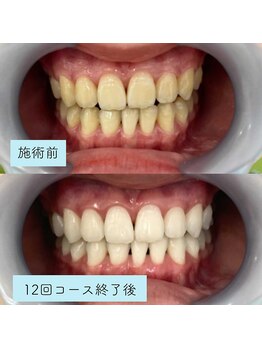 アイブロウ33/ホワイトニング　before/after