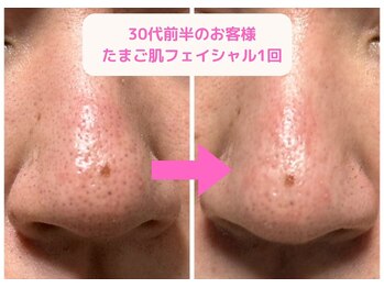 ヒーリング アンド ビューティー ナナ(Healing&Beauty nana)/たまご肌フェイシャルの症例