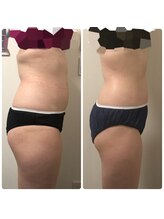 リボディ プラチナ(Rebody platinum)/ボディスカルプト×ボディケア