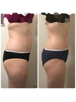 リボディ プラチナ(Rebody platinum)/ボディスカルプト×ボディケア