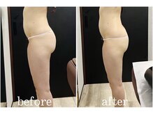 サロン ラズリ(SALON Lazuli)/【1回施術】筋膜リリース痩身