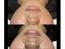 アストリア(ASTORIA)の雰囲気(高周波と光で引き上げ!!)