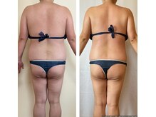 アクアモア/アクアモアの痩身★BeforeAfter