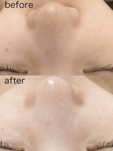 アトレ アンド ミューズ(Attrait×Muse)/ハイドラ毛穴洗浄(パック付)