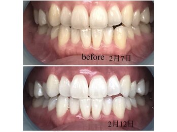 ドリームローズ(Dream Rose)/歯のホワイトニング!