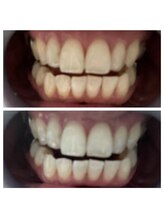 ボゴス(BOGOSS)/セルフホワイトニング