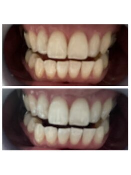 ボゴス(BOGOSS)/セルフホワイトニング