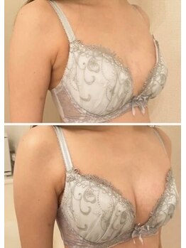 美人バスト 小倉店/バストアップ◇症例◇