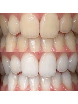 エクシアホワイトニング 戸田公園店/お客様のビフォーアフター