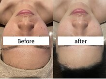 インチャント(enchant)/日焼けダメージ　こんなに変わる