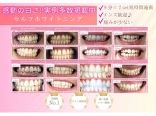 エクシアホワイトニング 天王寺店/ホワイトニングビフォーアフター