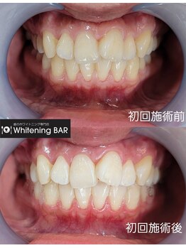 ホワイトニングバー 静岡パルコ店/初回ビフォーアフターをご紹介