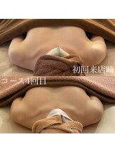 森の時計/症例写真:バスト編　コース4回目